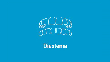 Diastema