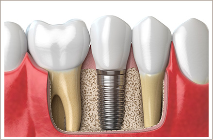 Implante Dentário