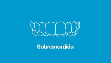 sobremordida