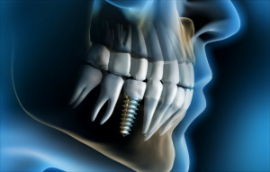 implante dentário dói